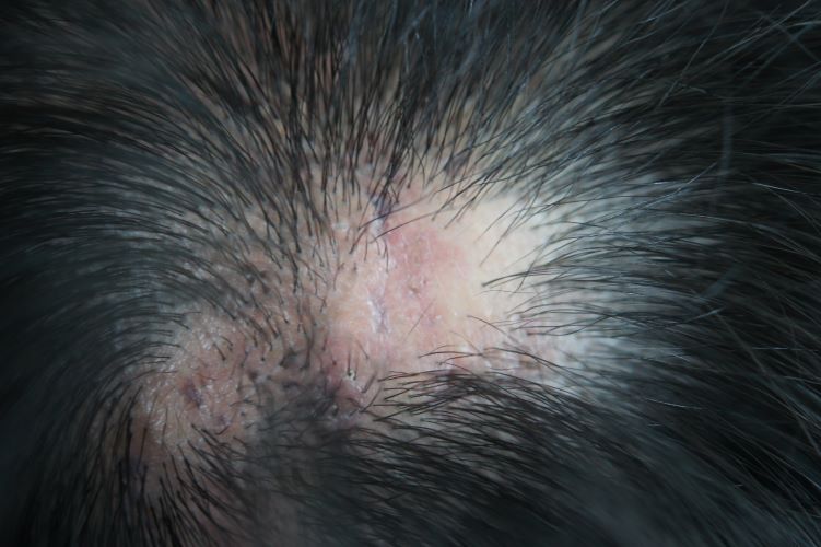 Hair loss from scarring alopecia
