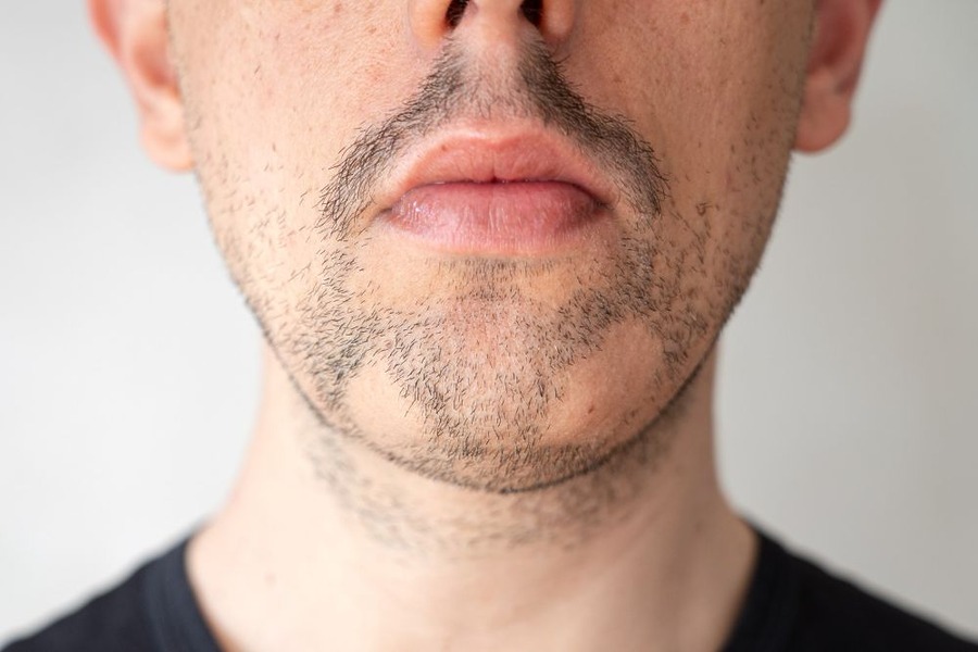 7 Common Causes For Patchy Beard Growth