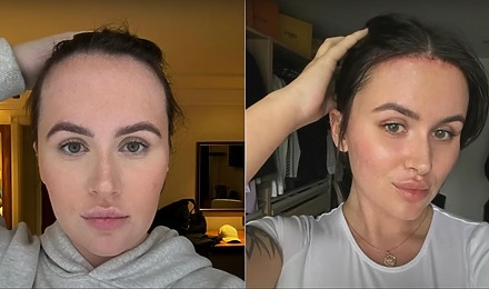 Beth Halsey&rsquo;s Forehead Reduction: How It Changed Her Life