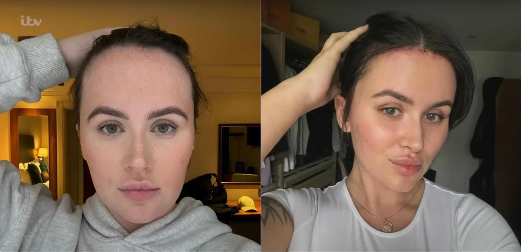 Influencer Beth Halsey before and after her forehead reduction surgery