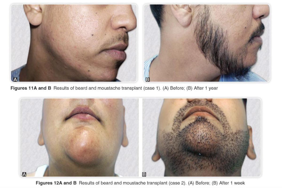 Before and after beard transplant (top). Beard transplant results (bottom).