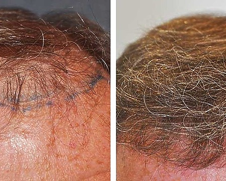 UK Hair Transplant Cost 2026: Average Price & Cost Per Graft, Wimpole Clinic