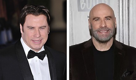 John Travolta&rsquo;s Hair Transplant: Toupee Or Not Toupee?