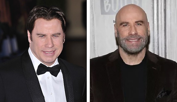 John Travolta&rsquo;s Hair Transplant: Toupee or not Toupee?