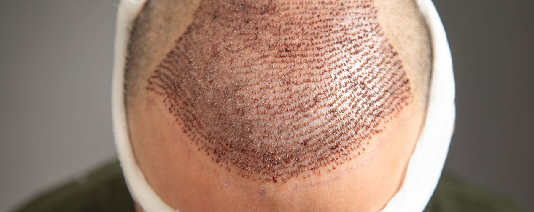 Man after a hair transplant