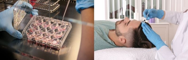 Does Stem Cell Hair Treatment Work? And What Are The Risks?