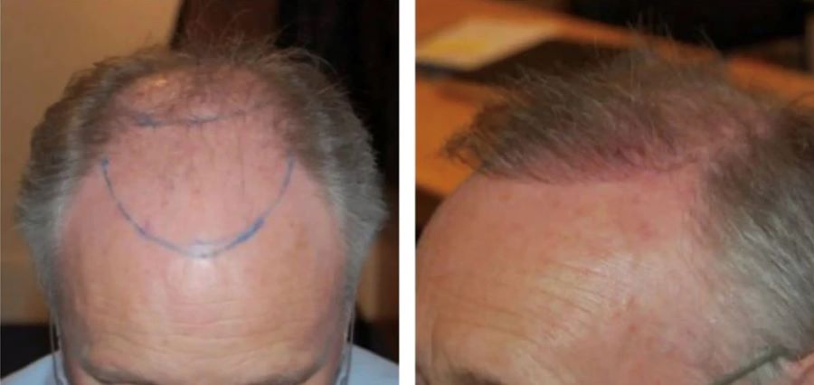 FUE hair transplant after 3 months