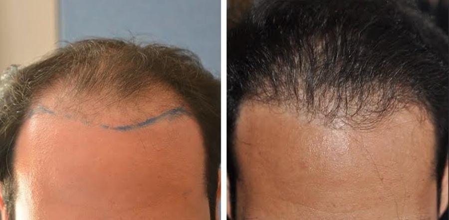 FUT hair transplant before and after