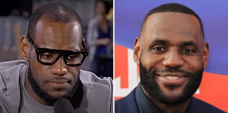LeBron James’ Hairline: Did LeBron James Have A Hair Transplant?
