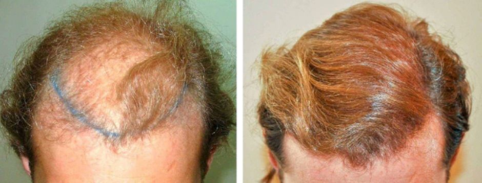 Man before and after hair transplant at Wimpole Clinic