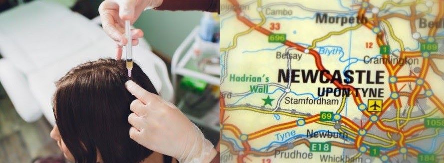 PRP Hair Treatment Newcastle: All You Need To Know