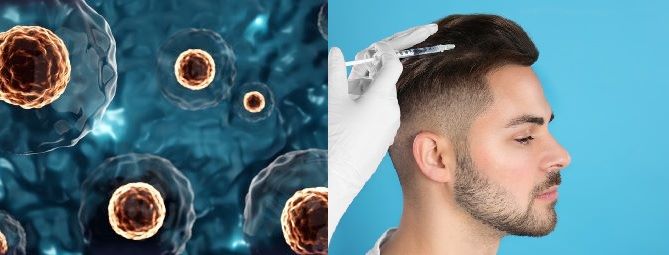 What Does Stem Cell Hair Treatment Cost And Is It Worth It?