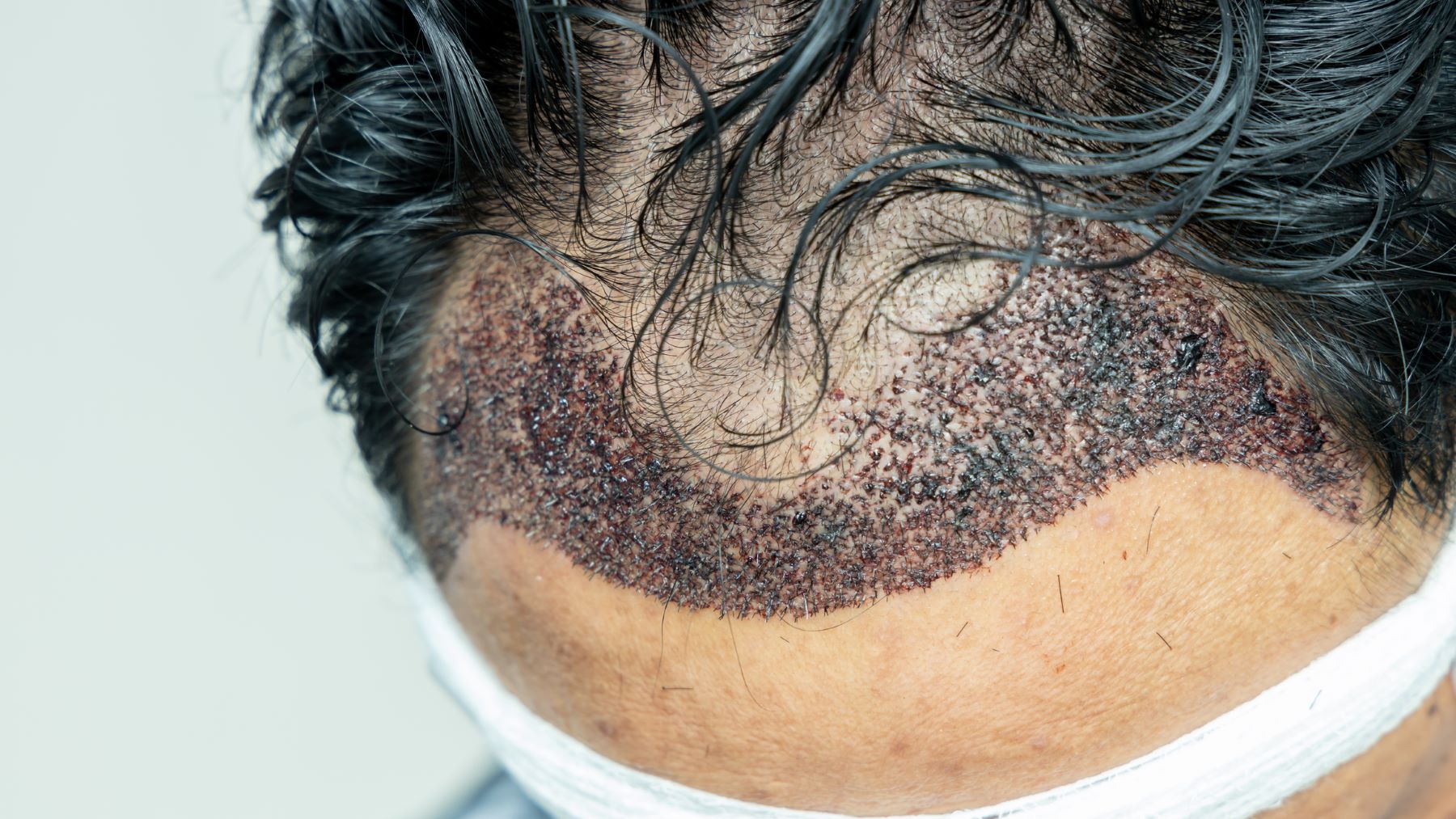 hair transplant recovery
