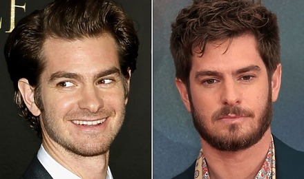 Andrew Garfield Hair Transplant