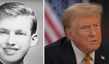 Donald Trump’s Hair: Did He Have A Hair Transplant?