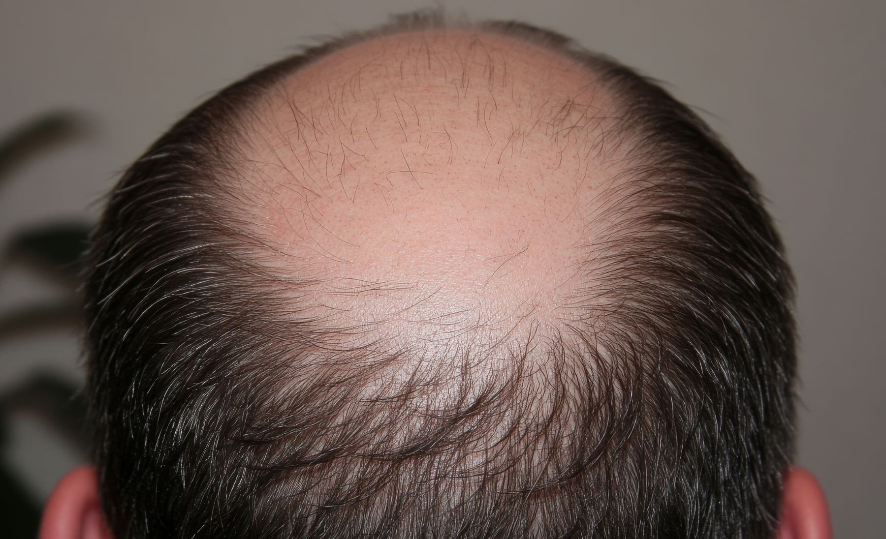 What Is Hair Miniaturisation And How Can You Reverse It?