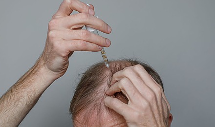 Does Minoxidil Expire
