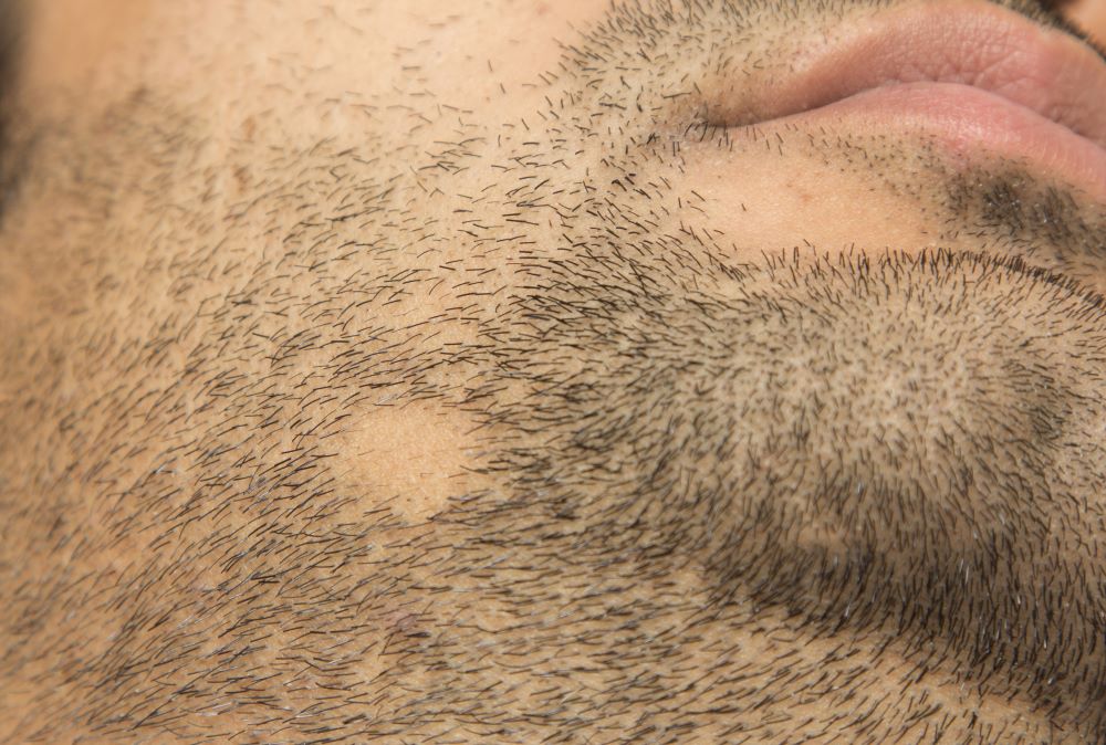 Alopecia barbae