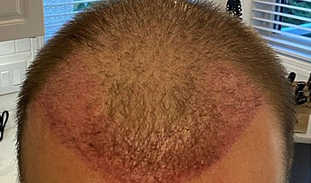 How Long Does Hair Transplant Redness Normally Last?