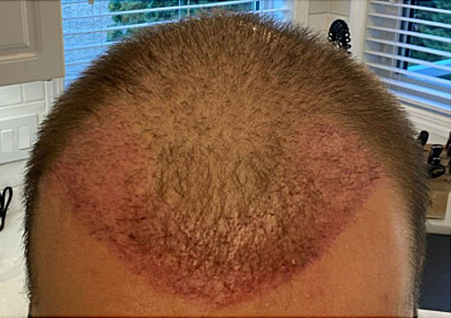 How Long Does Hair Transplant Redness Normally Last?