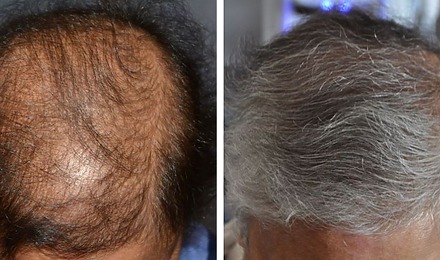 How Long Does A Hair Transplant Last?