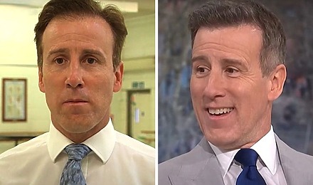Anton Du Beke Hair Transplant