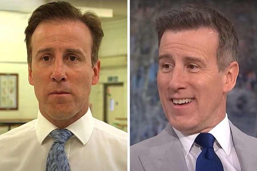 Anton Du Beke Hair Transplant
