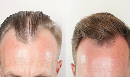 Hair Implants For Men: Procedure, Results, Costs & Recovery