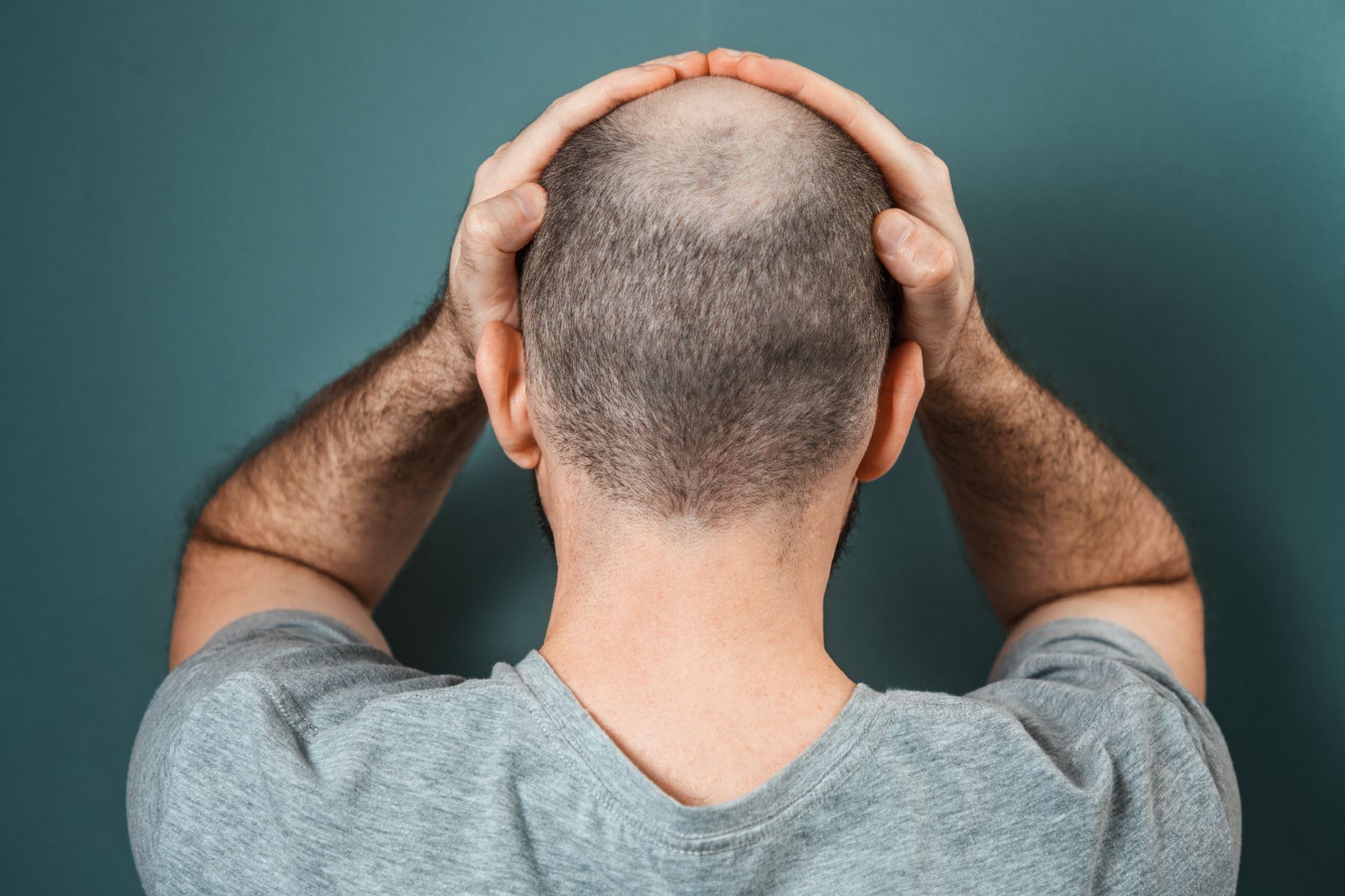 Man trying to stop male pattern baldness