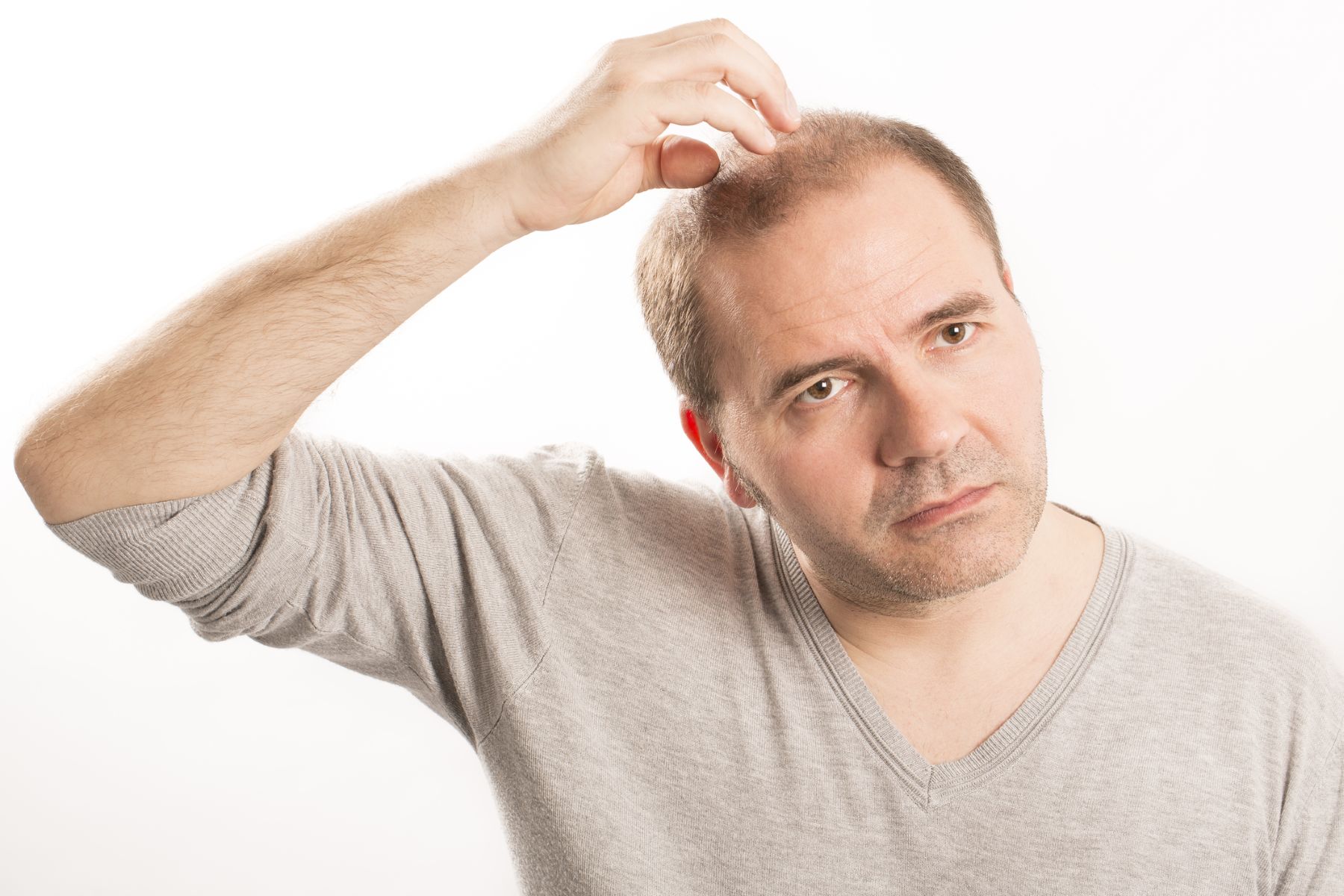 Man with hair loss from poor maintenance