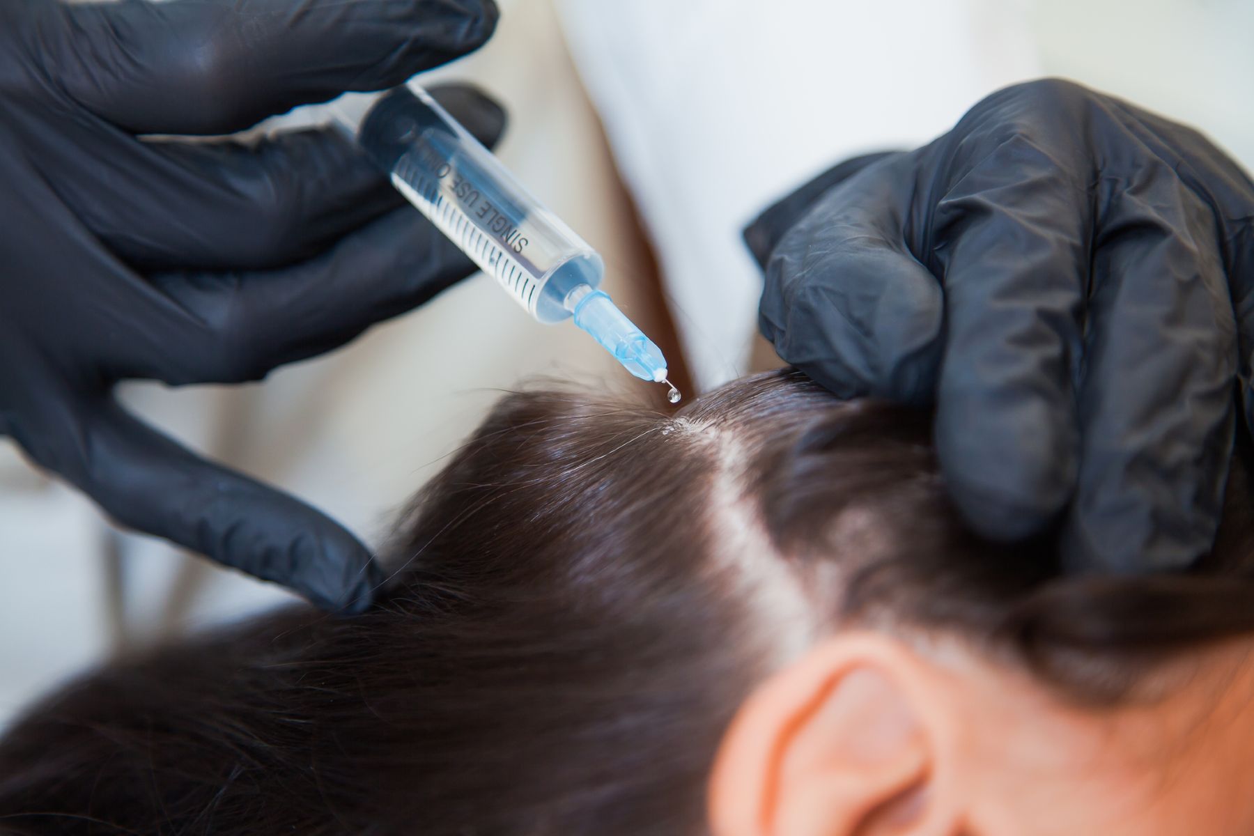 PRP hair treatment