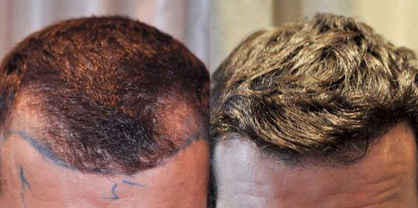 Patient before and after a temple hair transplant at the Wimpole Clinic
