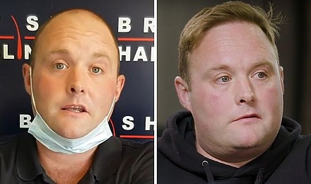 Peter Dale “Tubes” Hair Transplant - All You Need To Know