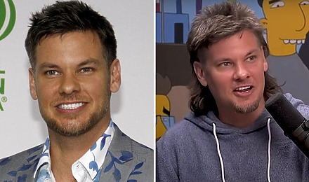 Theo Von Hair Transplant