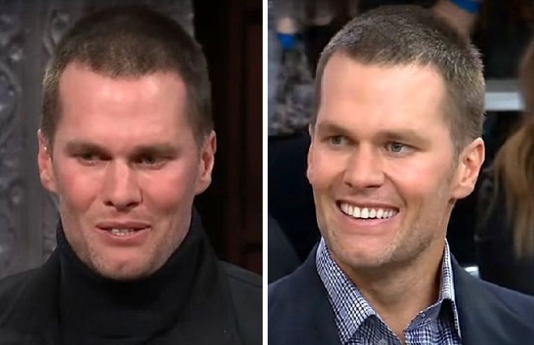 Tom Brady with hair loss, in 2018
