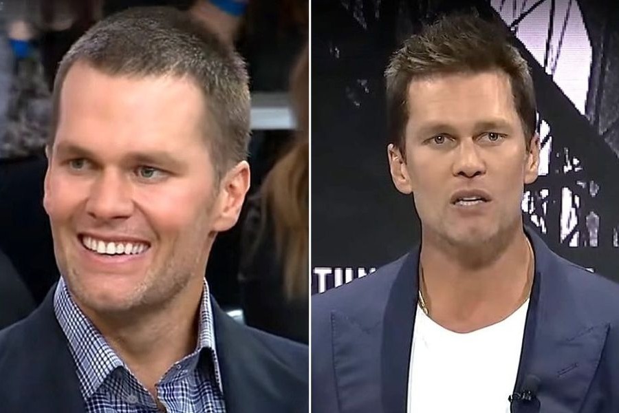 Tom Brady’s Hair Transplant: Did It Really Happen?