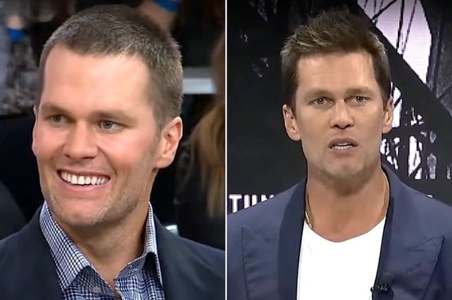 Tom Brady hair transplant