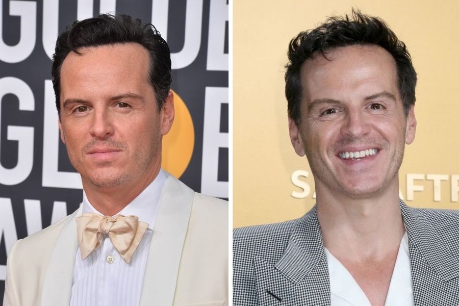 Andrew Scott’s Hair Transplant - Did It Really Happen