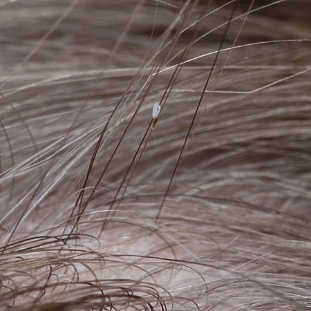 Hair lice