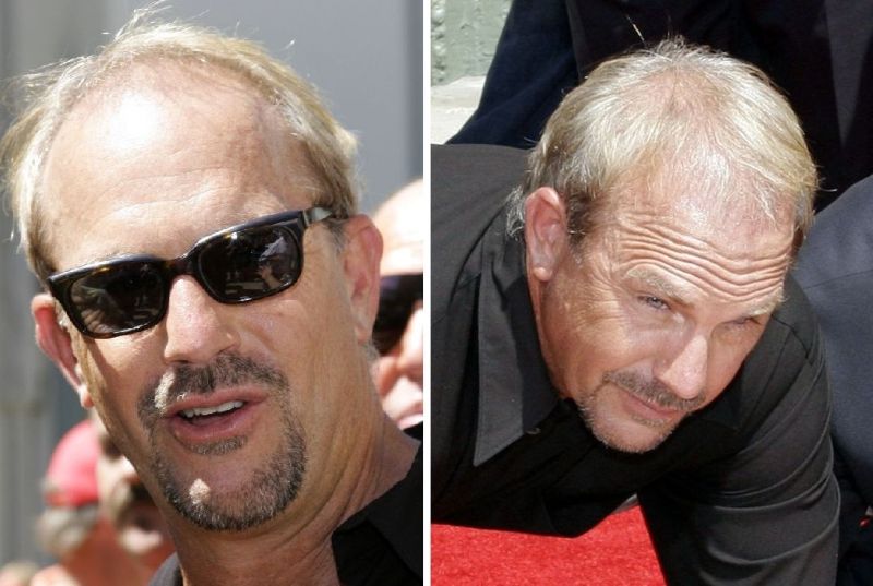 Kevin Costner shortly before his hair transplant
