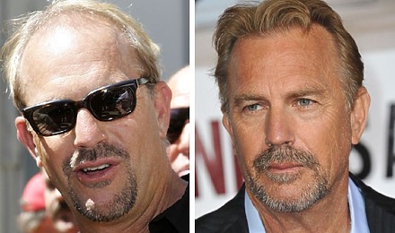 Kevin Costner’s Hair Transplant: Everything You Need To Know