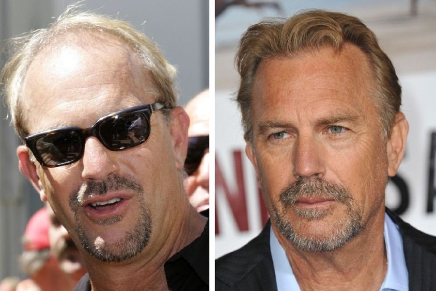 Kevin Costner’s Hair Transplant: Everything You Need To Know