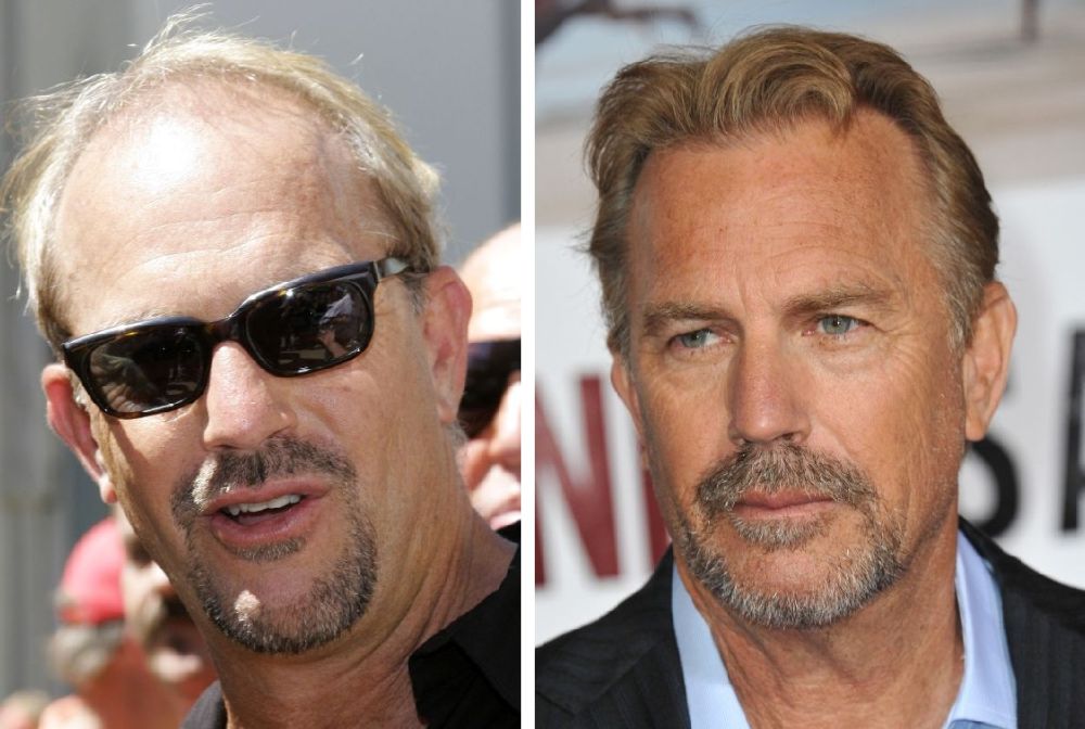 Kevin Costner hair transplant