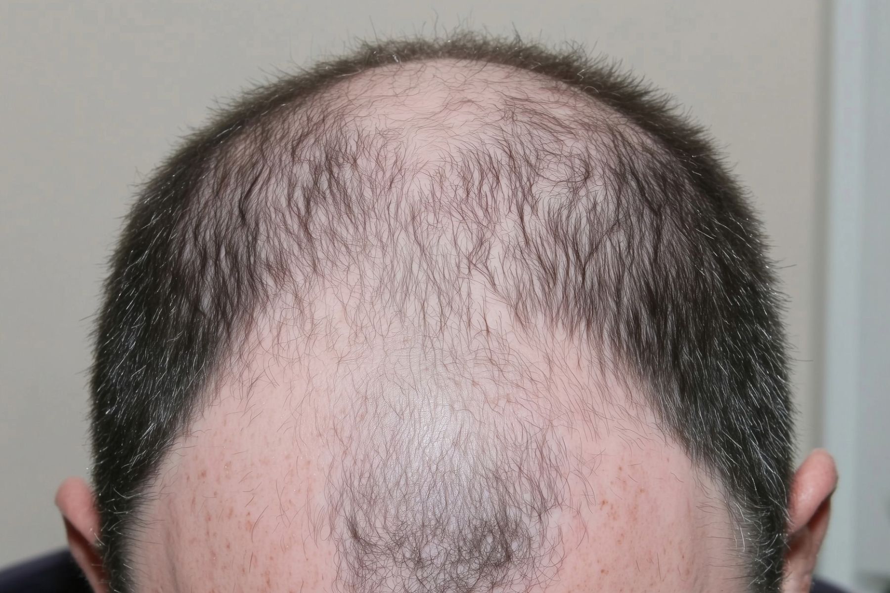 Male pattern baldness