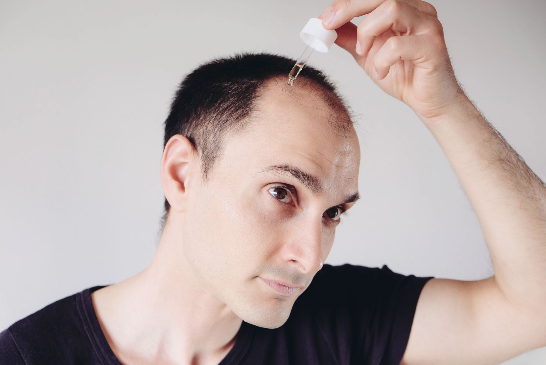 Man using topical Finasteride to reduce depression risk