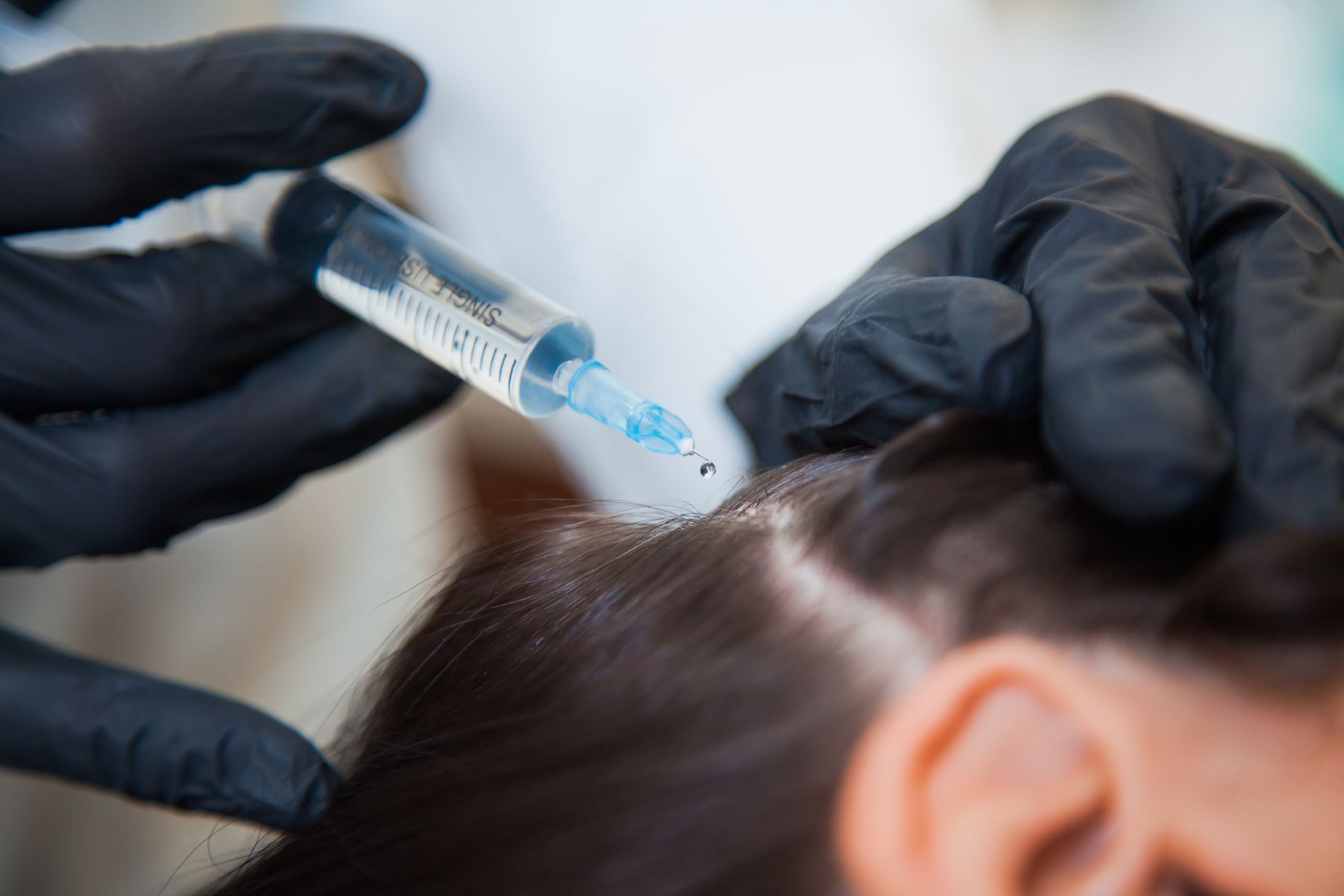 PRP hair treatment