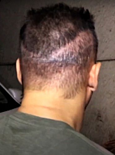 Salman Khan’s FUT scar