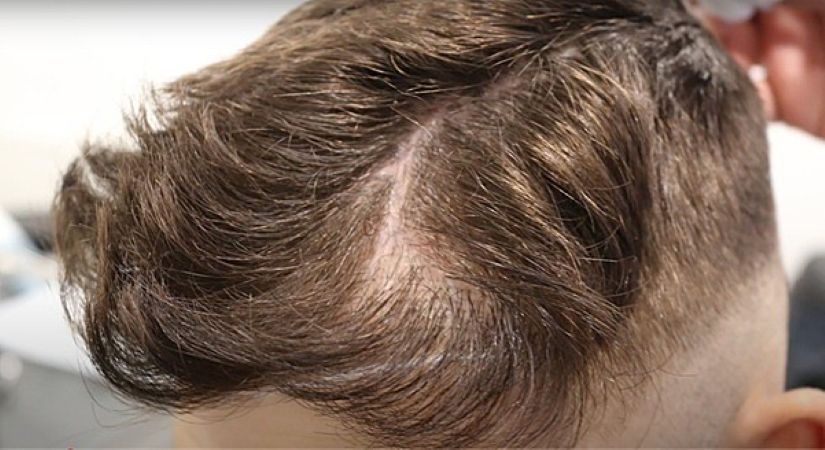 Jake Quickenden’s scalp scar