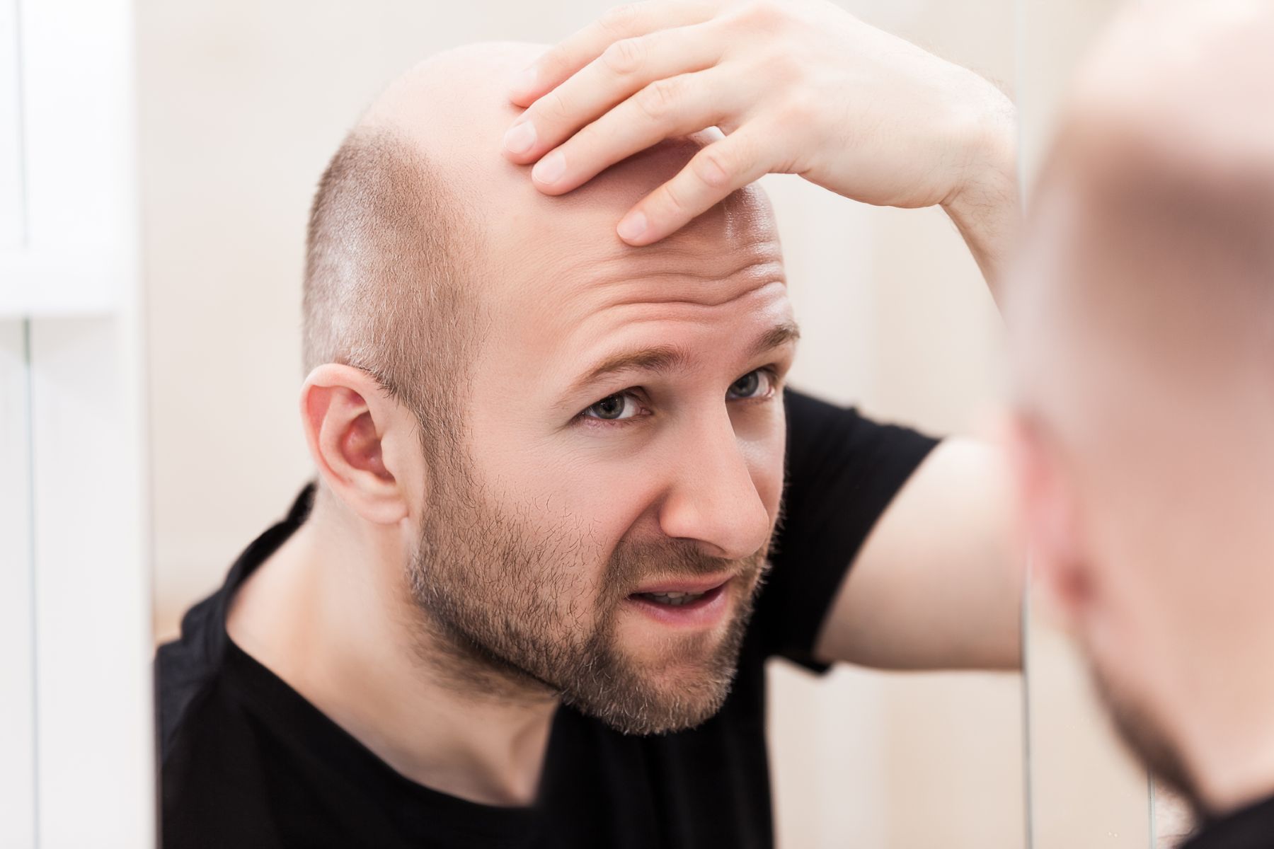 male pattern baldness