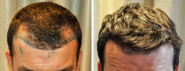 man before and after his FUE hair transplant